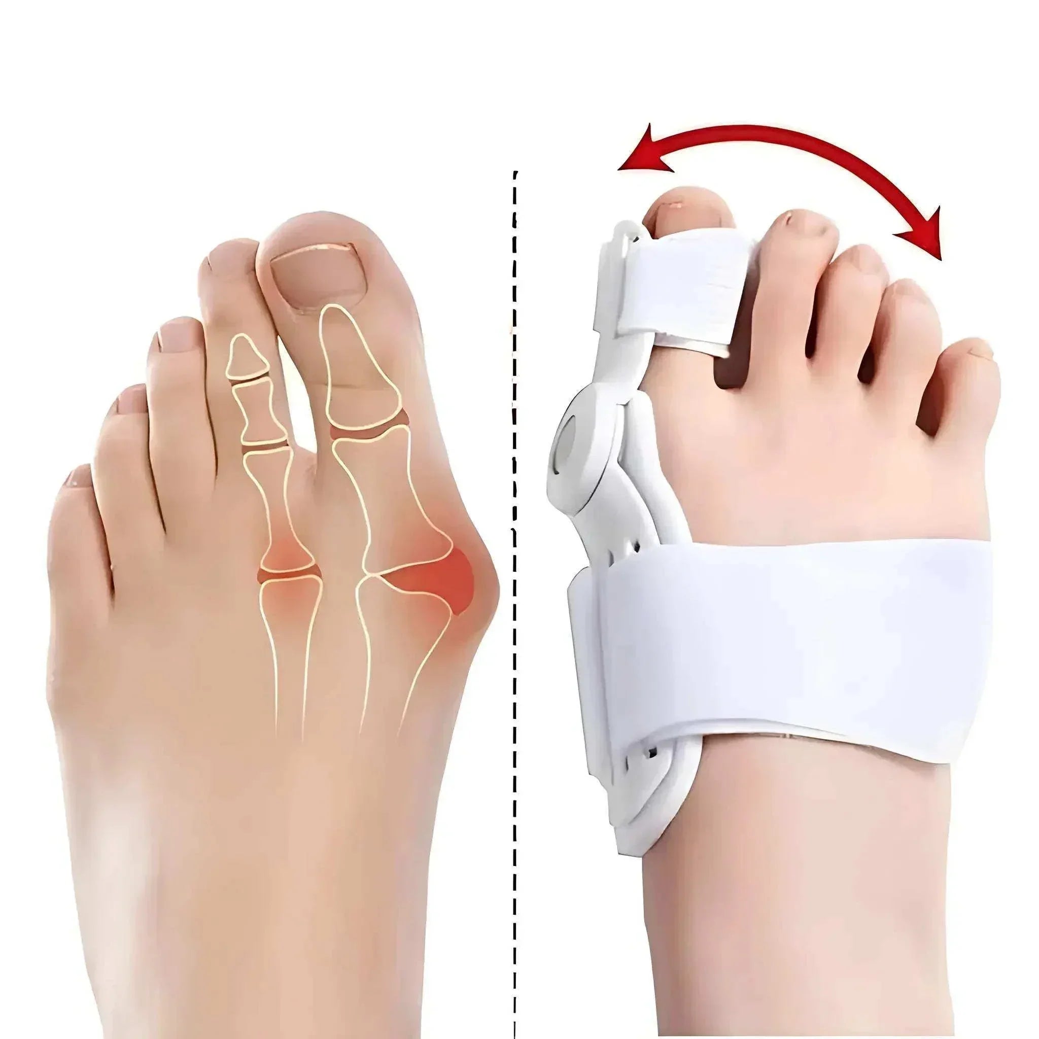 Corretor Ortopédico de Joanete Premium